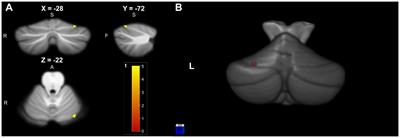 Cerebellar white and gray matter abnormalities in temporal lobe epilepsy: a voxel-based morphometry study